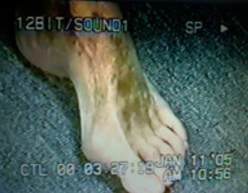 Complex Regional Pain Syndrome on foot