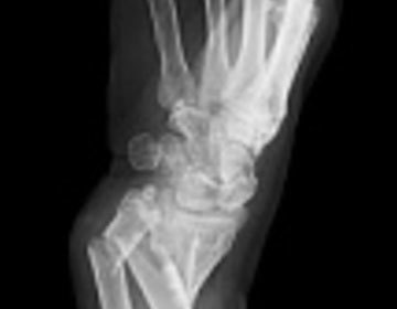 X-Ray of a fractured wrist