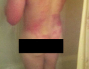 Victim displaying chemical burns from a work accident